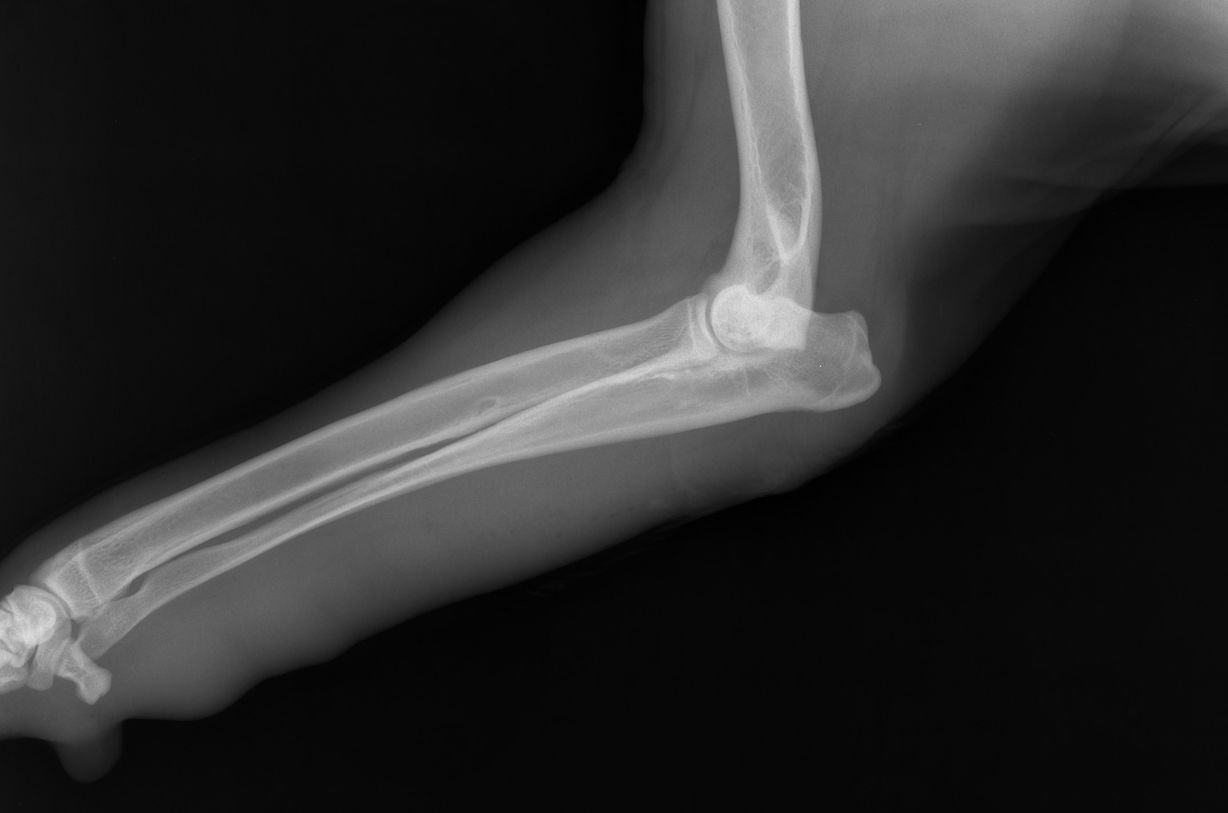 Was ist Ellenbogendysplasie?